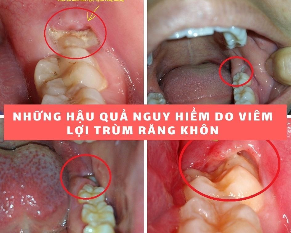 NHỮNG HẬU QUẢ NGUY HIỂM VỀ VIÊM LỢI TRÙM RĂNG KHÔN BẠN CẦN BIẾT