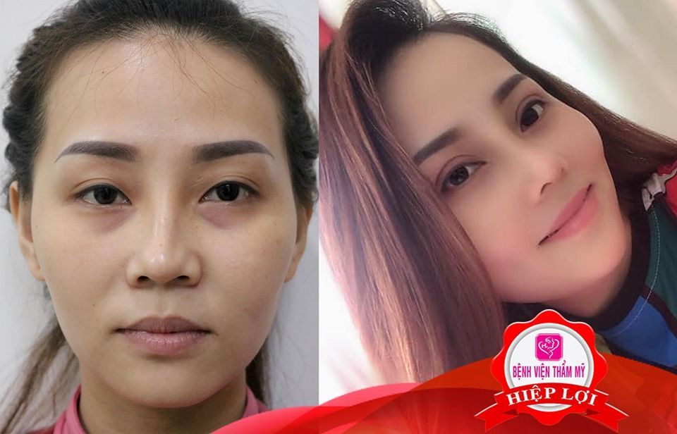 Chị Huyền (37 tuổi, Biên Hoà) tự tin khoe gương mặt xinh đẹp hơn xưa chỉ sau phẫu thuật thẩm mỹ