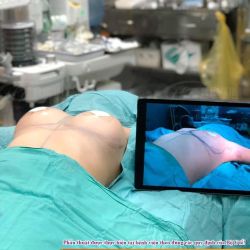 Trước và sau phẫu thuật nâng ngực tại Dr Hoàng Tuấn ngay trên bàn mổ