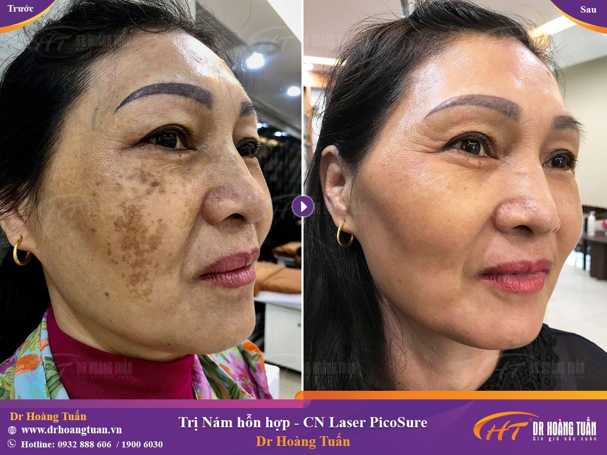 Điều trị nám khó ở độ tuổi U50 không còn là vấn đề nan giải khi đến với Dr Hoàng Tuấn