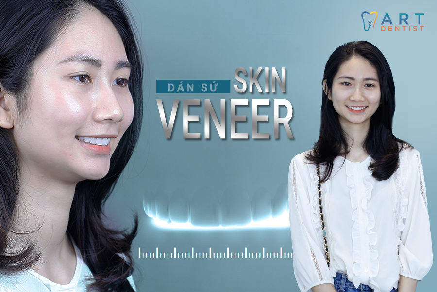 Skin Veneer  Định nghĩa lại  ĐẲNG CẤP nha khoa  THẨM MỸ