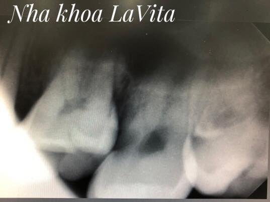 Trước khi nghỉ lễ mà khách hàng của LaVita phải nhổ 1 đôi răng số 8 mới yên tâm được