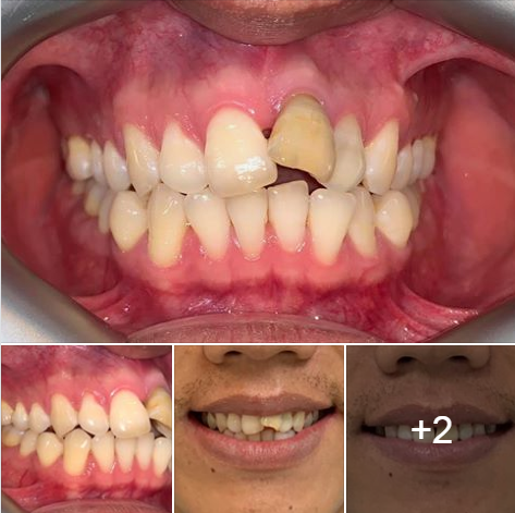 Invisalign cho ca khó: nhổ răng 4, kéo lùi răng cửa