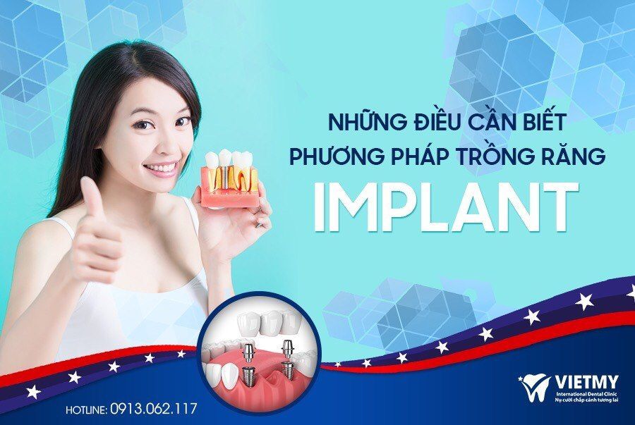 NHỮNG ĐIỀU CẦN BIẾT VỀ PHƯƠNG PHÁP TRỒNG RĂNG IMPLANT