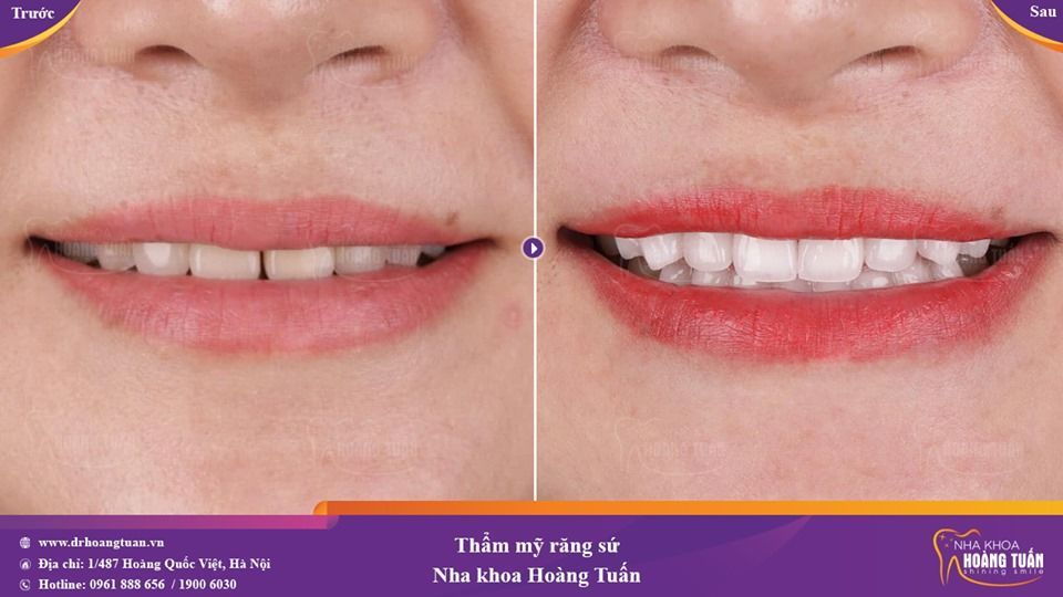 Hình ảnh kết quả trước và ngay sau thực hiện phục hình răng sứ tại Nha khoa thẩm mỹ Hoàng Tuấn