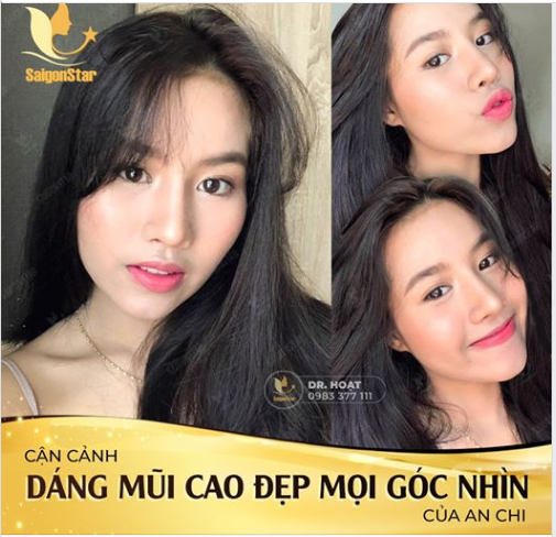 CẬN CẢNH DÁNG MŨI ĐẸP MỌI GÓC NHÌN CỦA AN CHI SAU 1 THÁNG NÂNG MŨI CẤU TRÚC SỤN SURGIFORM TẠI DR HOẠT