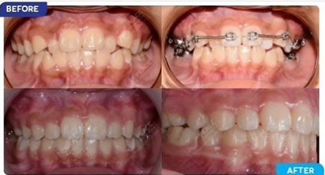 Chỉnh răng mọc lệch bằng phương pháp niềng răng tại Peace Dentistry
