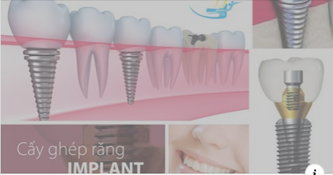 Công nghệ trồng răng Implant - Phương pháp phục hình răng mất tối ưu nhất hiện nay là gì