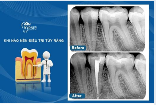 Điều trị tủy răng là gì?