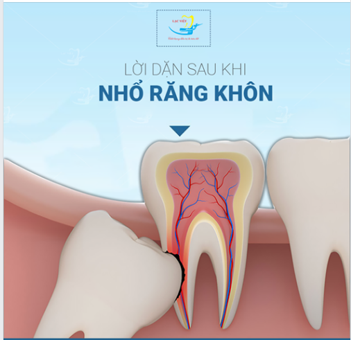 LỜI DẶN SAU KHI NHỔ RĂNG KHÔN BẠN CẦN NHỚ