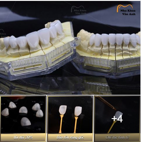 Mặt dán sứ VENEER - giải pháp hoàn hảo điều trị răng THƯA, XỈN MÀU, KHẤP KHỂNH - KHÔNG MÀI NHỎ RĂNG