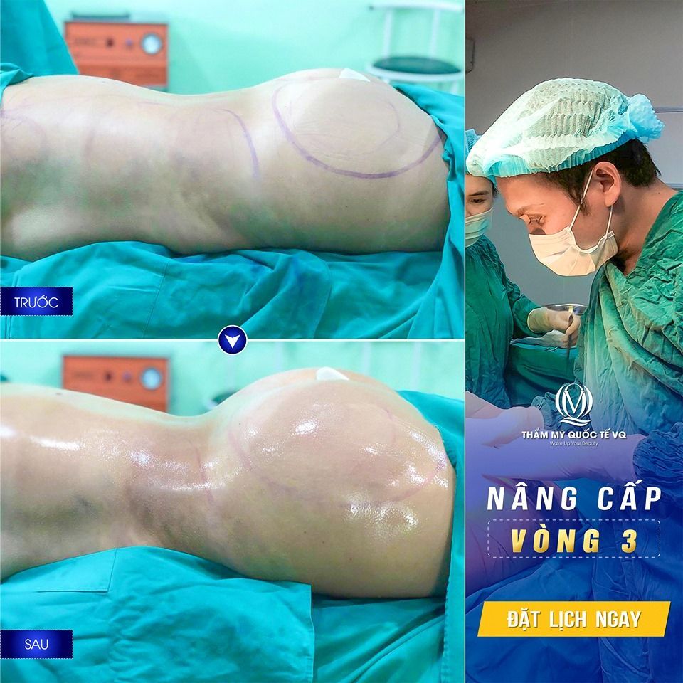 NÂNG CẤP VÒNG 3 KẾT HỢP SÓNG PLASMA PHỤC HỒI THẦN TỐC