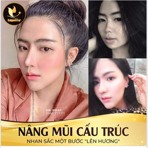 NÂNG MŨI CẤU TRÚC - NHAN SẮC MỘT BƯỚC "LÊN HƯƠNG"