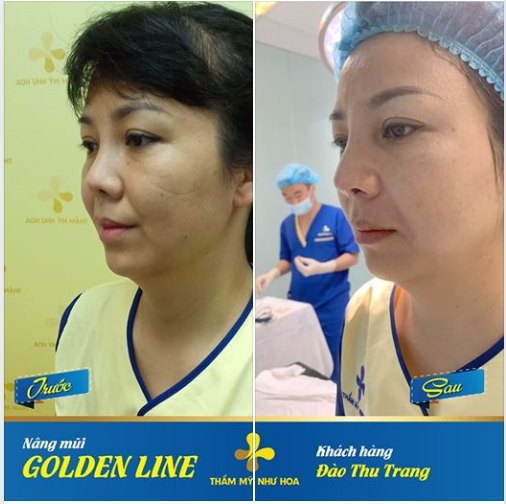 Nâng mũi Golden Line cải thiện tình trạng sống mũi võng, đầu mũi hếch