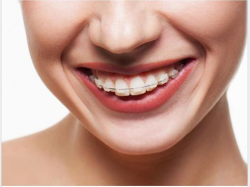 Niềng răng mắc cài sứ là phương pháp chỉnh nha giúp khắc phục những khiếm khuyết về răng từ đơn giản đến phức tạp như: răng hô, răng móm, răng khấp khểnh nặng