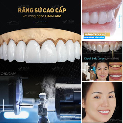 Thẩm mỹ răng sứ với công nghệ CAD/CAM và Digital Smile Design