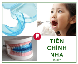 TIỀN CHỈNH NHA LÀ GÌ