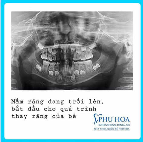 Bé sinh năm 2012, bắt đầu quá trình thay răng. Phía dưới là mầm răng vĩnh viễn.