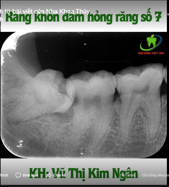 CẢNH BÁO - Răng khôn nằm ngang đâm vào răng số 7 - gây biến chứng.