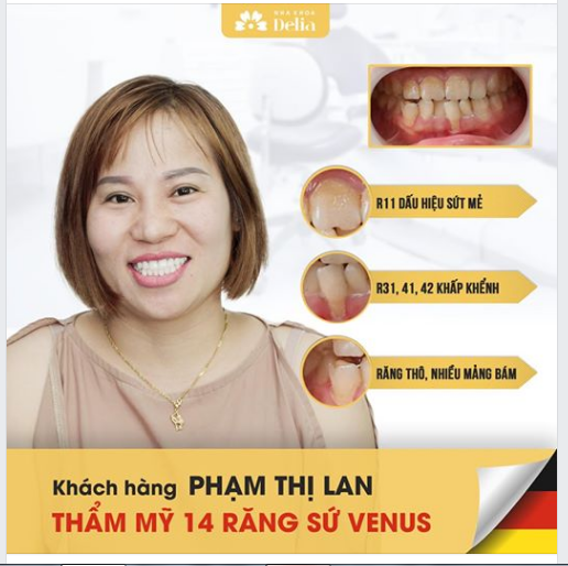 Case 6209: Răng khấp khểnh, sứt mẻ, răng thô, nhiều mảng bám. Chỉ sau 2 ngày thay đổi hoàn toàn diện mạo.