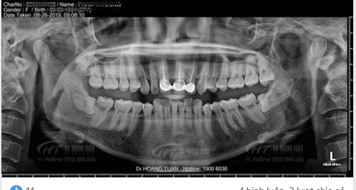 Chụp X-quang để chỉnh hàm hô, phát hiện răng mọc ngầm - miễn phí nhổ răng luôn!