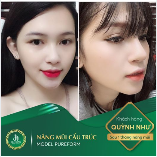 Feedback chị khách hàng Quỳnh Như đã thực hiện nâng mũi cấu trúc Model Pureform tại Thẩm mỹ Dr.Hoan được 1 tháng tuổi