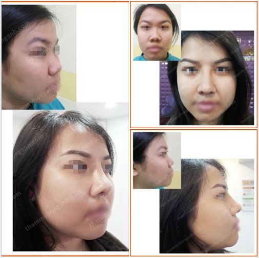 Giờ mũi đã đẹp mọi góc nhìn rồi nha! Hãy tự tin & hạnh phúc hơn trong cuộc sống nhé!