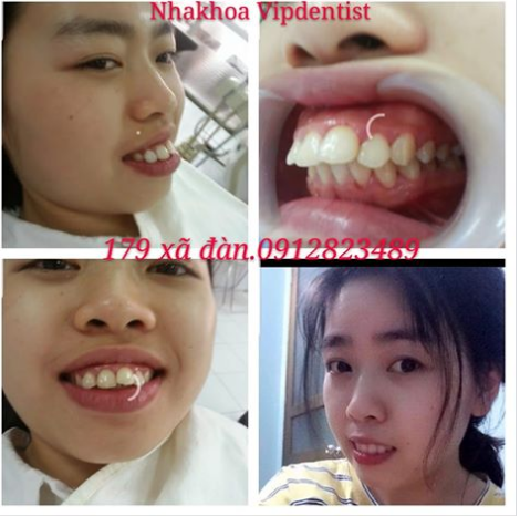 Hình ảnh Bạn Thúy Ngần Trước và sau khi nắn chỉnh được thực hiện bởi Bác sĩ Nguyễn Lương Huyền với phương pháp không phải nhổ Răng.