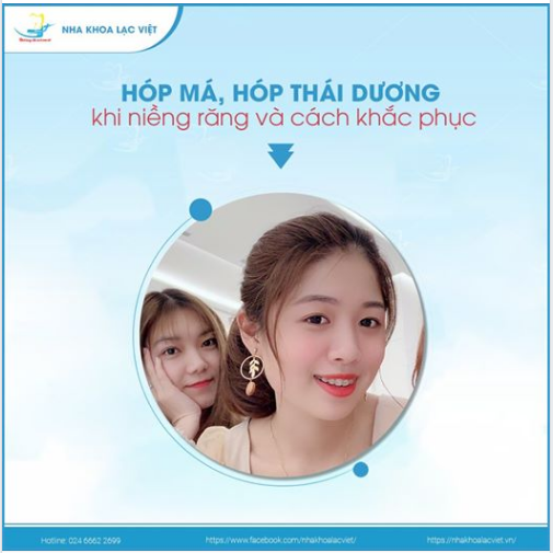 HÓP MÁ, HÓP THÁI DƯƠNG SAU KHI NIỀNG RĂNG DO ĐÂU