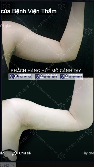 HÚT MỠ BẮP TAY - VỀ NGAY SAU LÀM