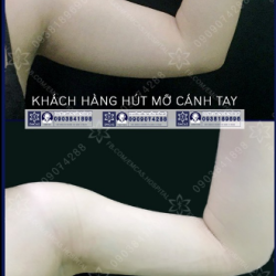 HÚT MỠ BẮP TAY - VỀ NGAY SAU LÀM