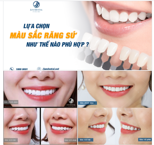 Khách hàng thông thái của Jun Dental không chỉ quan tâm đến dáng răng, mà họ còn dành sự quan tâm lớn đến màu sắc răng sứ.