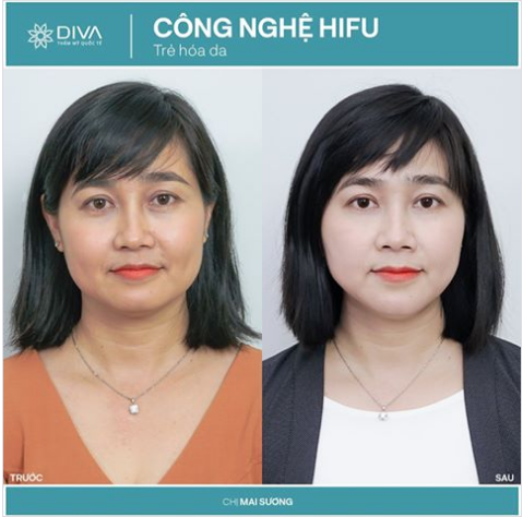 NÂNG CƠ TRẺ HÓA DA CÔNG NGHỆ HIFU – TRẢ LẠI THANH XUÂN CHO LÀN DA BẠN