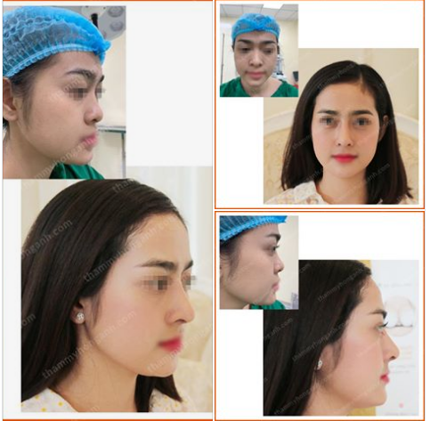 NÂNG MŨI CẤU TRÚC  mũi đẹp toàn diện