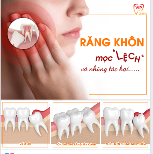  RĂNG KHÔN MỌC LỆCH GÂY NGUY HIỂM NHƯ THẾ NÀO