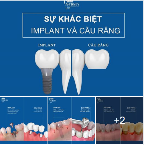 SỰ KHÁC NHAU GIỮA CẤY GHÉP IMPLANT VÀ LÀM CẦU RĂNG SỨ