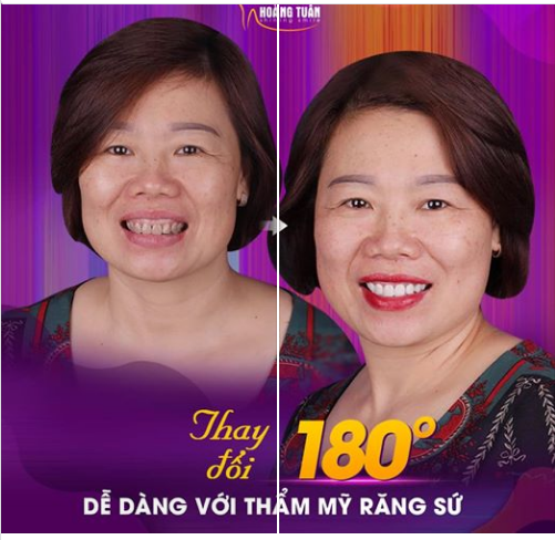 THAY ĐỔI 180 ĐỘ DỄ RÀNG VỚI THẨM MỸ RĂNG SỨ