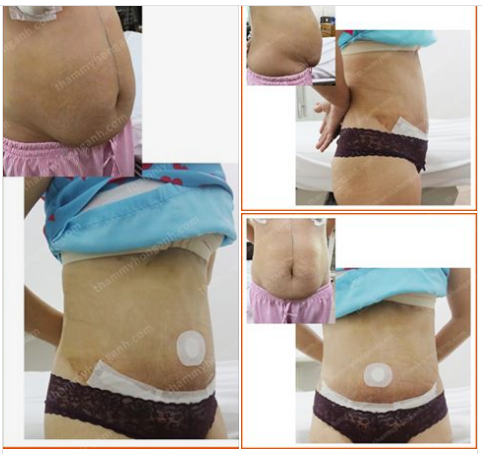 THU GỌN THÀNH BỤNG 1 LẦN DUY NHẤT