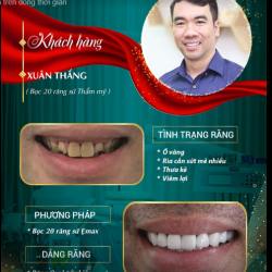 Tình trạng răng miệng trước đây anh Thắng gặp phải vừa khiến anh gặp khó khăn trong ăn nhai, lại cản trở anh rất nhiều khi giao tiếp.