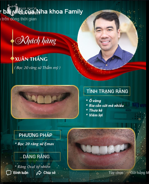 Tình trạng răng miệng trước đây anh Thắng gặp phải vừa khiến anh gặp khó khăn trong ăn nhai, lại cản trở anh rất nhiều khi giao tiếp.