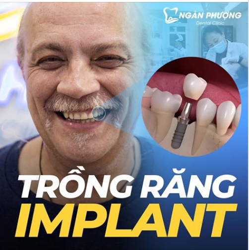 Trồng răng IMPLANT - PHỤC HÌNH RĂNG HOÀN HẢO