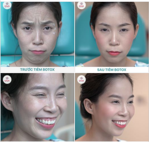 BOTOX – CHIẾN BINH CHỐNG NHĂN HÙNG MẠNH