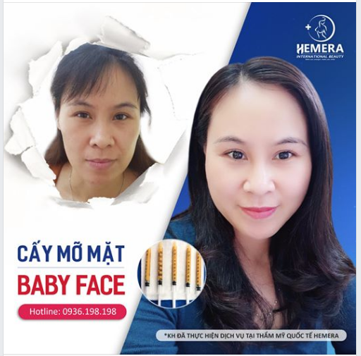 Cấy mỡ Baby Face - Giải cứu khuôn mặt hốc hác