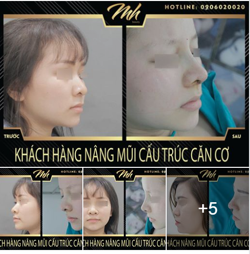  Chỉ với sự thay đổi ở dáng mũi đã giúp cô nàng của chúng ta tự tin hơn, nâng tầm nhan sắc toàn diện hơn.