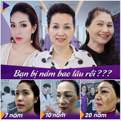 Dù bị nám bao nhiêu năm, Dr Hoàng Tuấn cũng điều trị sạch cho bạn.