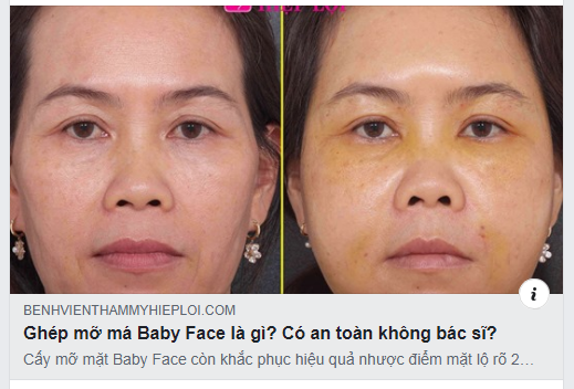 Ghép mỡ mặt Baby Face là gì