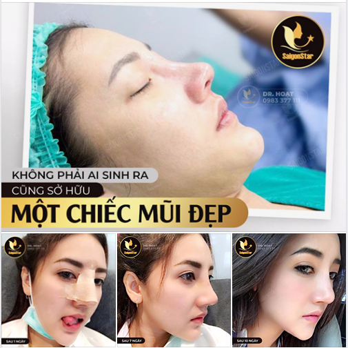  KHÔNG PHẢI AI SINH RA CŨNG SỞ HỮU MỘT CHIẾC MŨI ĐẸP