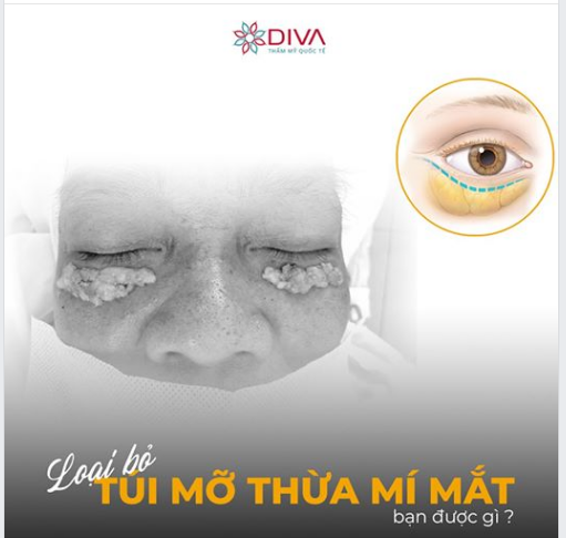 LOẠI BỎ TÚI MỠ THỪA MÍ MẮT BẠN ĐƯỢC GÌ