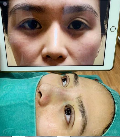 Mắt nhiều nếp mí phụ, nếp mí không đều đã được khắc phục bằng phương pháp nhấn mí Dr Hoàng Tuấn - cho đôi mắt 2 mí căng tròn, cân đối hơn!
