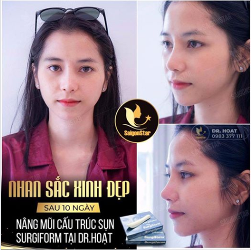 NHAN SẮC XINH ĐẸP SAU 10 NGÀY NÂNG MŨI CẤU TRÚC SỤN SURGIFORM TẠI DR HOẠT